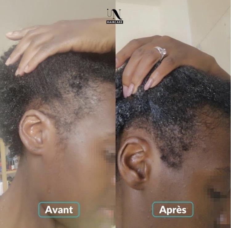 Avant après Cure pousse de cheveux 1 mois