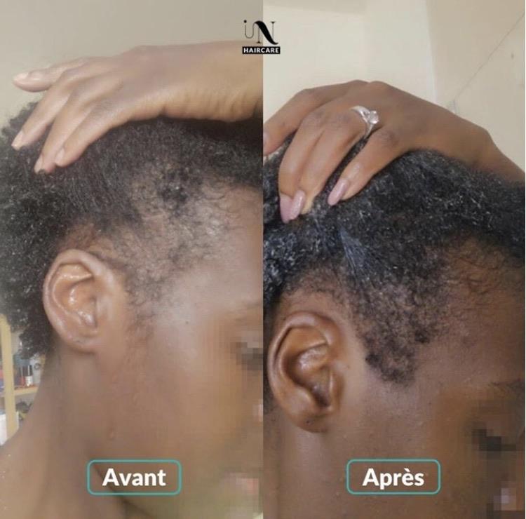 Avant après Cure pousse de cheveux 1 mois 